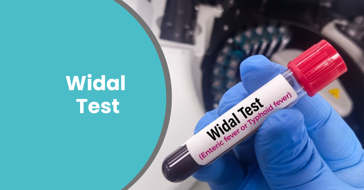 Understanding the Widal Test: A Reliable Tool in Typhoid Diagnosis
